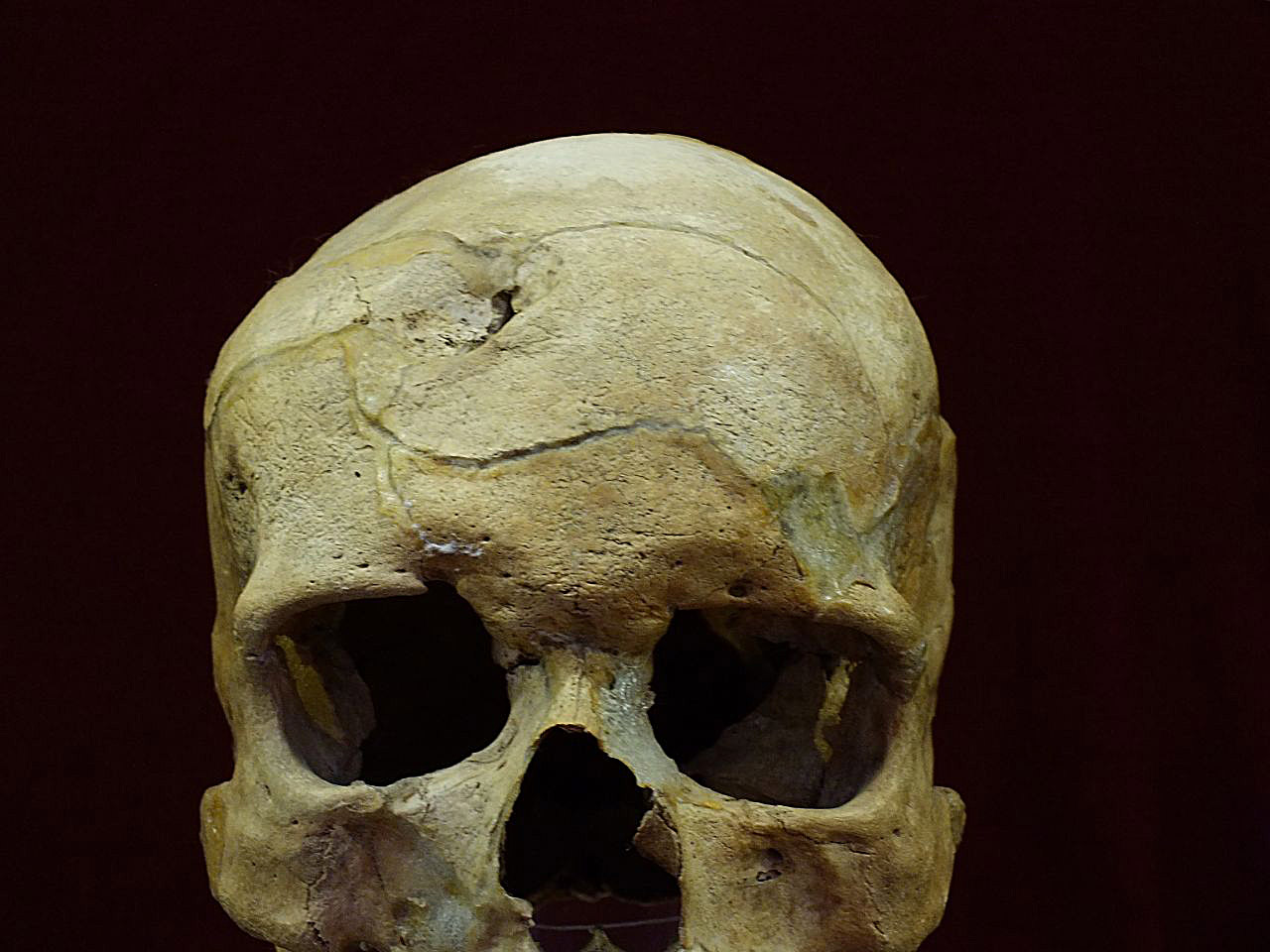 Jelképes trepanációval rendelkező langobard férfi koponyája <br />(Vörs, Tótok dombja, Somogy megye)